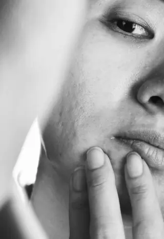 Understand Root Cause of acne & take control of it.